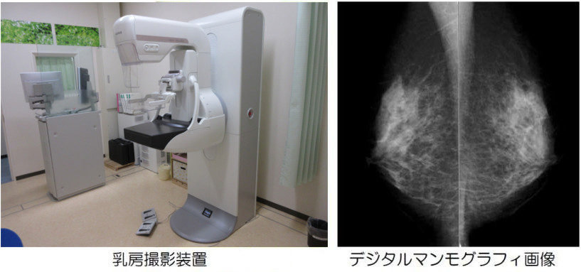 乳房撮影装置・デジタルマンモグラフィ画像